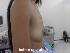 plastic-surgery-breast-augmentation 